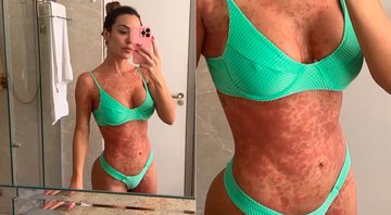 Letícia Santiago mostrou corpo cheio de manchas em seu Instagram Stories - Foto: Reprodução/ Instagram@le_santiago