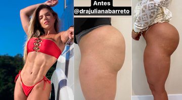 Roberta Zuniga mostrou antes e depois de procedimento no bumbum - Foto: Reprodução/ Instagram@robertazuniga